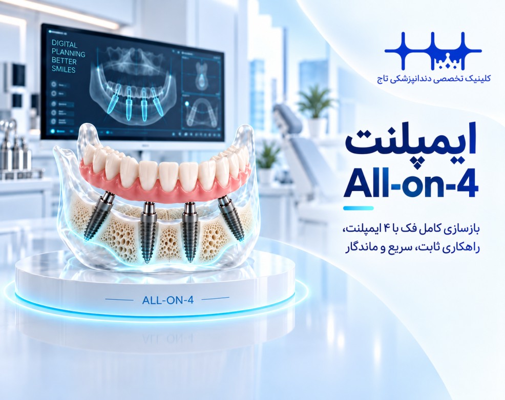 ایمپلنت All-on-4: راهنمای جامع برای بازسازی کامل لبخند شما