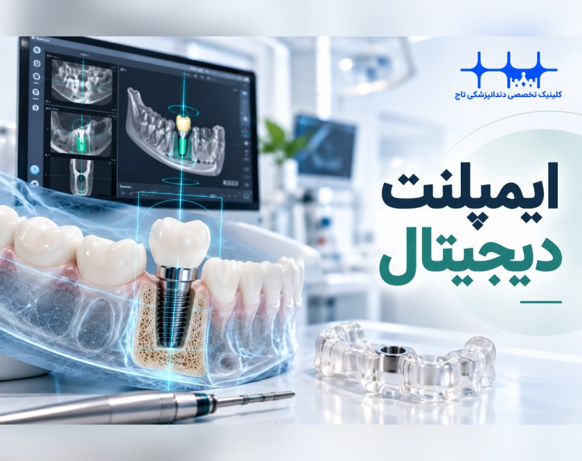 ایمپلنت دیجیتال