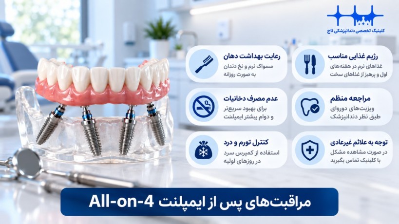 مراقبت‌های بعد از ایمپلنت All-on-4
