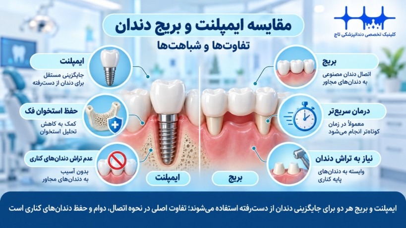 مقایسه ایمپلنت و بریج دندان