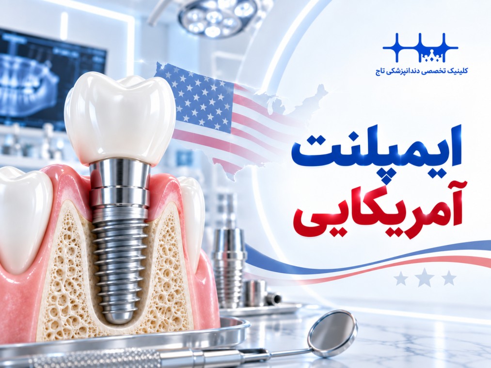 ایمپلنت آمریکایی: راهنمای جامع انتخاب، قیمت و مزایا در سال 1405