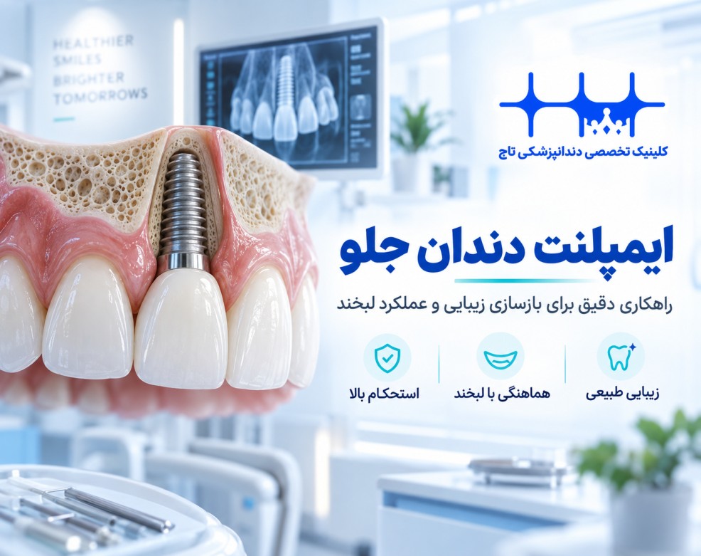 ایمپلنت دندان جلو؛ مراحل، هزینه، ماندگاری و نکات زیبایی