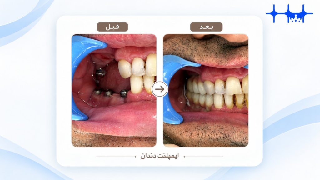 ایمپلنت سه دندان بالا و چهار دندان پایین