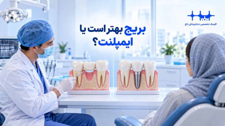 بریج بهتر است یا ایمپلنت؟ راهنمای جامع انتخاب بهترین روش جایگزینی دندان
