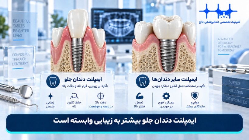 تفاوت ایمپلنت دندان جلو با سایر دندان‌ها