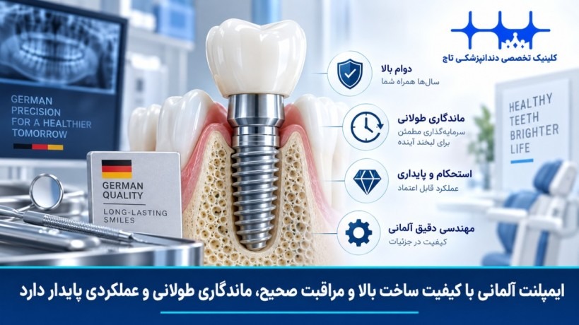 ماندگاری و دوام ایمپلنت آلمانی