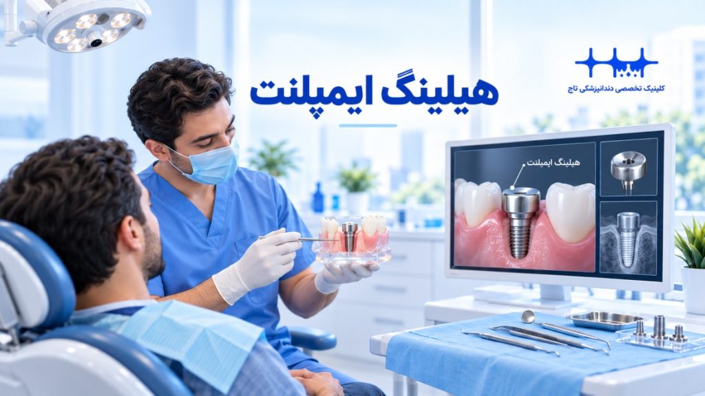 هیلینگ ایمپلنت چیست؟ راهنمای جامع برای درک بهتر فرآیند کاشت دندان