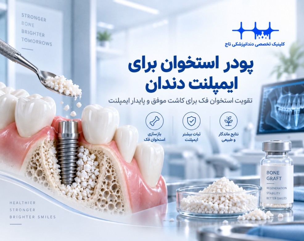 پودر استخوان برای ایمپلنت دندان: راهنمای جامع پیوند استخوان