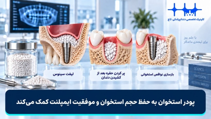 کاربرد پودر استخوان در ایمپلنت